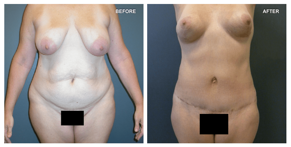 Abdominoplasty, female, age 48, 2 years after surgery by Jeffrey Gusenoff, MD